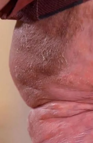 dr. pimple popper treats woman with rash that ‘smells like hot garbage’